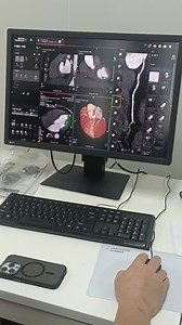 西门子CT冠脉CTA操作