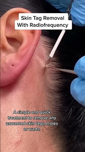 Skin Tag Removal With Radiofrequency - DrMedispa