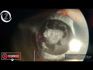 How to perform Nd YAG capsulotomy