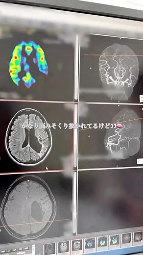脳動静脈奇形で倒れて生死を彷徨い…1年に1回のMRIと脳波検査結果🧠#寝たきりからの回復#脳動静脈奇形#脳#脳出血#10万人に1人#発#発症から4年#喋れなかった#片麻痺#理学療法士#作業療法士