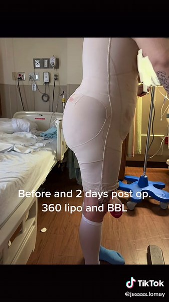 BBL Surgery and 360 Liposuction Insights