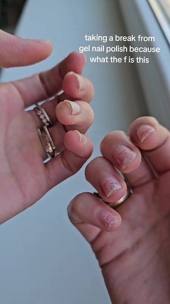 Skin Detached Under Nail: A Painful Experience