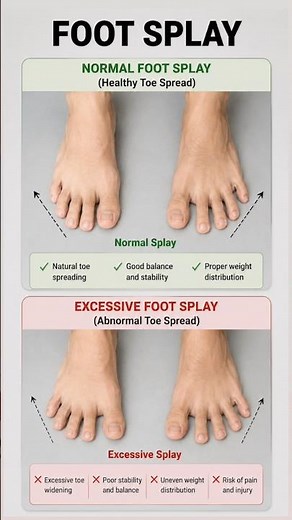 🦶 FOOT SPLAY EXPLAINED | Normal vs Excessive Splay