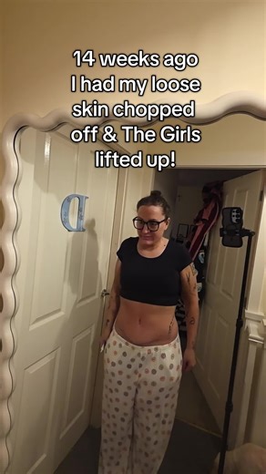 14 Weeks Post Tummy Tuck: Adjusting to My New Body