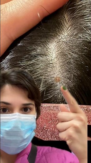 Removal of benign tumor & 3 biopsies all in one day #melanomaawareness