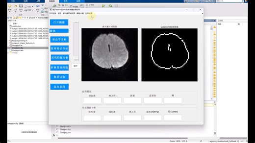 基于MATLAB的MRI医学图像处理系统