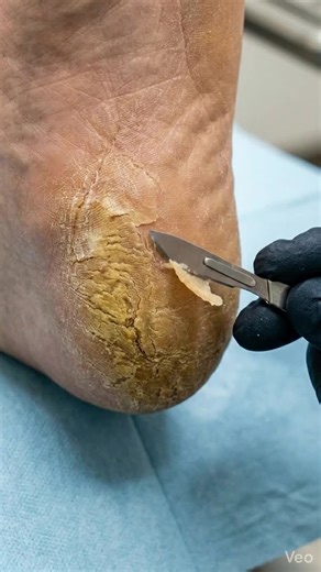 Extreme Callus Removal Explained! 🦶🔬 Watch this deeply satisfying medical procedure as thick, cracked skin is carefully removed from the heel to reveal the healthy tissue underneath—a perfect example of how our bodies build tough protective layers over time to handle friction, brought to you by Human Science Daily. #callusremoval #podiatry #satisfyingvideo #medicalscience #HumanScienceDaily #skincare #anatomy