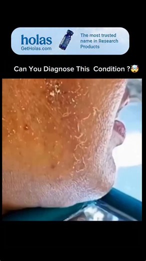 Explaining Biology | Cutaneous myiasis is a parasitic skin infestation caused by the larvae (maggots) of certain flies. The flies deposit eggs on the skin or in... | Instagram