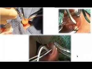 Umbilical Lines- Practice Pearls