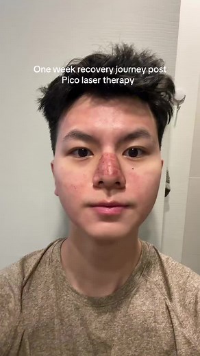 One Week Post Pico Laser Treatment: Skincare Results