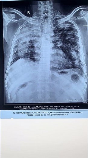 Opacity in lung field and differentials | Chest X Ray | #drmuskaan