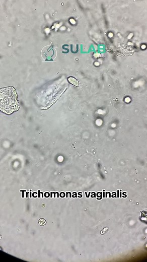 Triquemoniasis: Síntomas y Diagnóstico en Urina