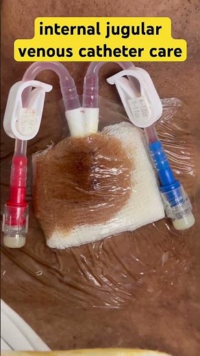 Internal jugular catheter care patient (IJC ) || central line catheter cleaning #centrallinecare