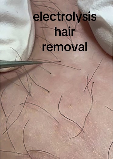 Electrolysis Hair Removal Techniques Explained