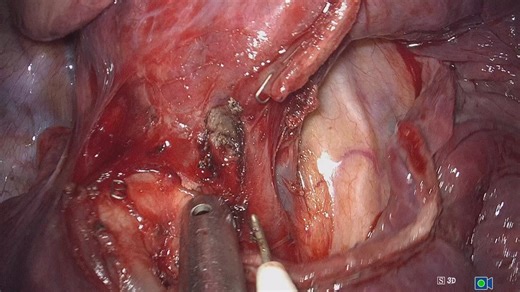 杨运海：单孔胸腔镜下右肺上叶前段切除术（live）