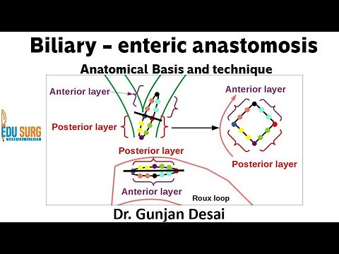 Roux-en-Y hepaticojejunostomy - anatomical basis and steps of surgery - Biliary-enteric anastomosis