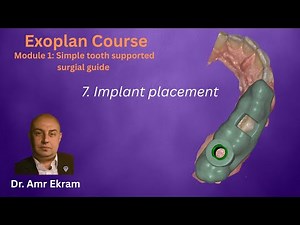 7 Implant placement in Exoplan