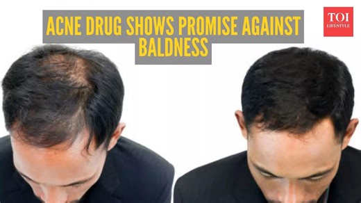 Breakthrough in finding cure for baldness: Common acne drug shows remarkable results in treating male pattern baldness