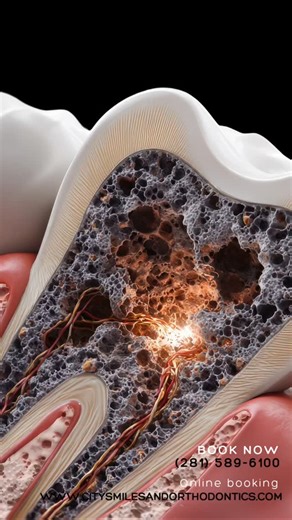 Unlike bones or skin, tooth enamel doesn’t regenerate once it’s damaged. That’s why small cavities, cracks, or enamel wear don’t “fix themselves” — they only get worse if ignored. The good news? Regular dental visits catch these issues early, when treatment is simpler, faster, and more comfortable. Your smile gives clues early — listening to it makes all the difference. Call us (281) 589-6100 and schedule your appointment. #citysmilesandorthodontics #toothenamel #dentalcheckup #healthysmile | Ci