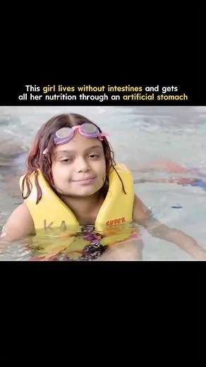 This young girl lives without intestines, surviving entirely through a machine that acts as her artificial stomach. She was born with a rare condition that left her unable to digest or absorb food normally. Doctors connected her to a system called Total Parenteral Nutrition (TPN) — which delivers nutrients directly into her bloodstream. Every drop of vitamins, fats, and proteins she needs is pumped through sterile tubes for hours each day. She can’t eat like others, but she’s learned to live a f