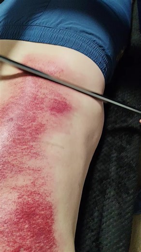 kinetic therapy iastm courses, cpd provider........ #iastm#guasha#masage #rehab