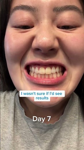 7-day teeth whitening challenge!