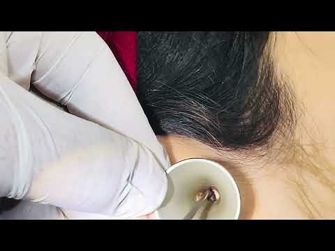 Successful Bilateral Impacted Cerumen Removal with Immediate Hearing Restoration.