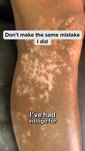 I spent years trying to cover my vitiligo. Makeup, camouflage products, special routines, even clinical treatments. It would look better for a while. Then the contrast would show again. New patches appeared where I didn’t expect them — around my mouth, my eyes, my hands. I started to believe the lie — that this was just something I had to live with. But then I watched Dr. Turner — a well-known dermatologist — explain something I’d never heard before: 👉 That vitiligo has very little to do with s