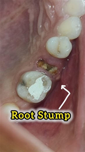 Painless Root Stump Extraction 🔥💪#drshivamverma #dentist #dentaltreatment #shorts #lakhimpurkheri