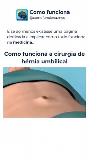 Como Funciona a Cirurgia de Hérnia Umbilical?