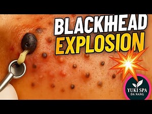 Satisfying Blackhead Removal ASMR | Full Face Extraction & Deep Facial
