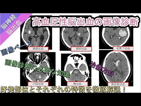 高血圧性脳出血の画像診断