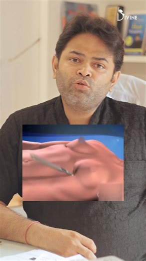 Dr Amit Gupta | 𝐀𝐫𝐞𝐨𝐥𝐚 𝐯𝐬. 𝐈𝐧𝐟𝐫𝐚𝐦𝐚𝐦𝐦𝐚𝐫𝐲: 𝐂𝐡𝐨𝐨𝐬𝐢𝐧𝐠 𝐘𝐨𝐮𝐫 𝐈𝐦𝐩𝐥𝐚𝐧𝐭 𝐀𝐩𝐩𝐫𝐨𝐚𝐜𝐡 𝑃𝑙𝑎𝑛𝑛𝑖𝑛𝑔 𝑎 𝑏𝑟𝑒𝑎𝑠𝑡 𝑖𝑚𝑝𝑙𝑎𝑛𝑡 𝑠𝑢𝑟𝑔𝑒𝑟𝑦? 𝐻𝑒𝑟𝑒’𝑠 𝑤ℎ𝑎𝑡 𝑡𝑜 𝑘𝑛𝑜𝑤 👇 Two main approaches —... | Instagram