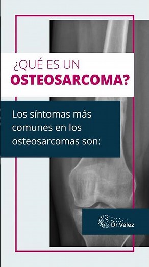 ¿Qué es un #osteosarcoma?