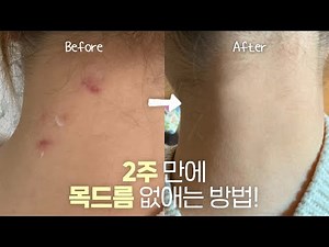 Advertisement❌ How to get rid of neck acne in 2 weeks! I found this real care product myself beca...