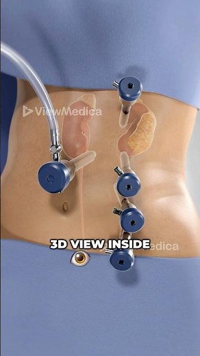Robot-Assisted Human Kidney Removal (3D Animation)