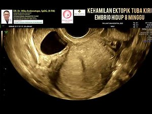 Ectopic pregnancy 8 weeks live embryo