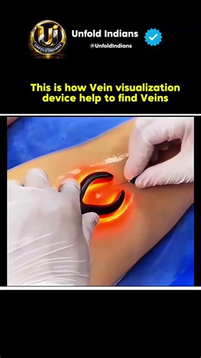 Amazing Vein Visualization Device That Uses Technology To Find Veins Instantly #tech