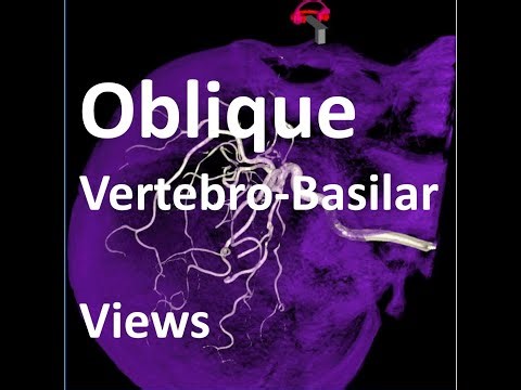 Oblique Angiographic Projections of Vertebral Artery