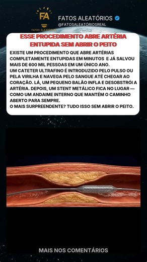 Sem cirurgia, sem corte — é assim que o stent salva o coração