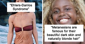 50 Times Human Genetics Led To Some Unique Body Characteristics