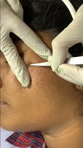 Best Comedones Extraction Treatment | Viral #shorts