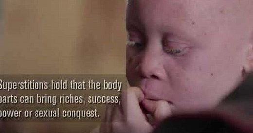 In parts of Africa, people with albinism are hunted for their body parts. The latest victim: a 9-year-old boy