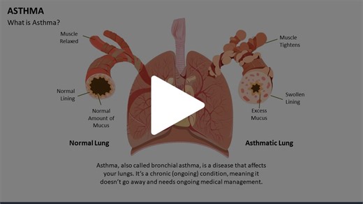 Asthma Animated Presentation - SketchBubble