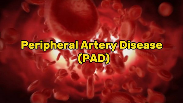 Peripheral arterial disease _ Symptoms, risks, and treatments