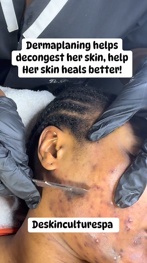 I Dermaplan over acne but skillfully avoid the active, very bumpy ones.What my client gets is a decongested, smoother face that actually starts healing, not spreading, tested and trusted over many times! #deskinculture #bestspainawka #skincare #whiteheads #awkaskincare. | Chinelo Stella