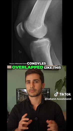Perfect Knee X-Ray Positioning: Tube Angle & Rotation