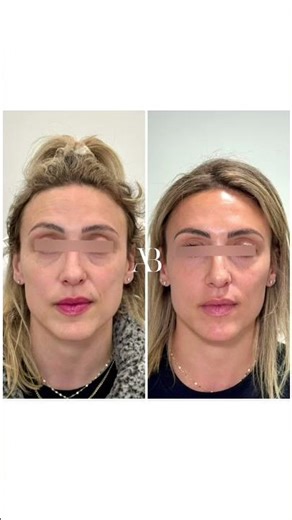 Sculptra Before & After