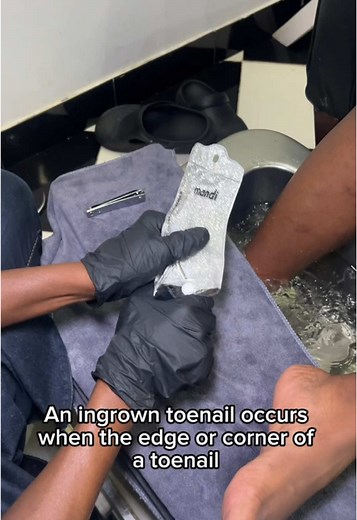 Gentle Ingrown Nail Removal Technique for Foot Care