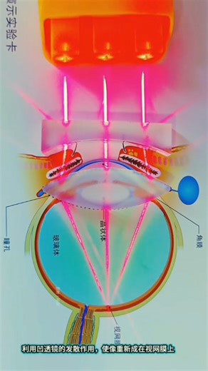 OftalmoClick on Instagram: "A visual demonstration of the optical behavior of different lenses. The physics behind vision, right in front of you. Enjoyed the demonstration? Save this post for reference and share it with your colleagues! ✨ Thanks for the contribution, @veronica34947"